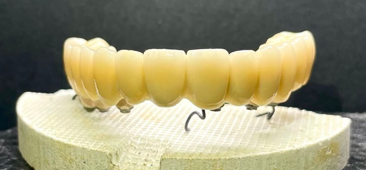 dentadura.metal.porcelana